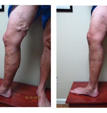 large-varicose-veins-thigh