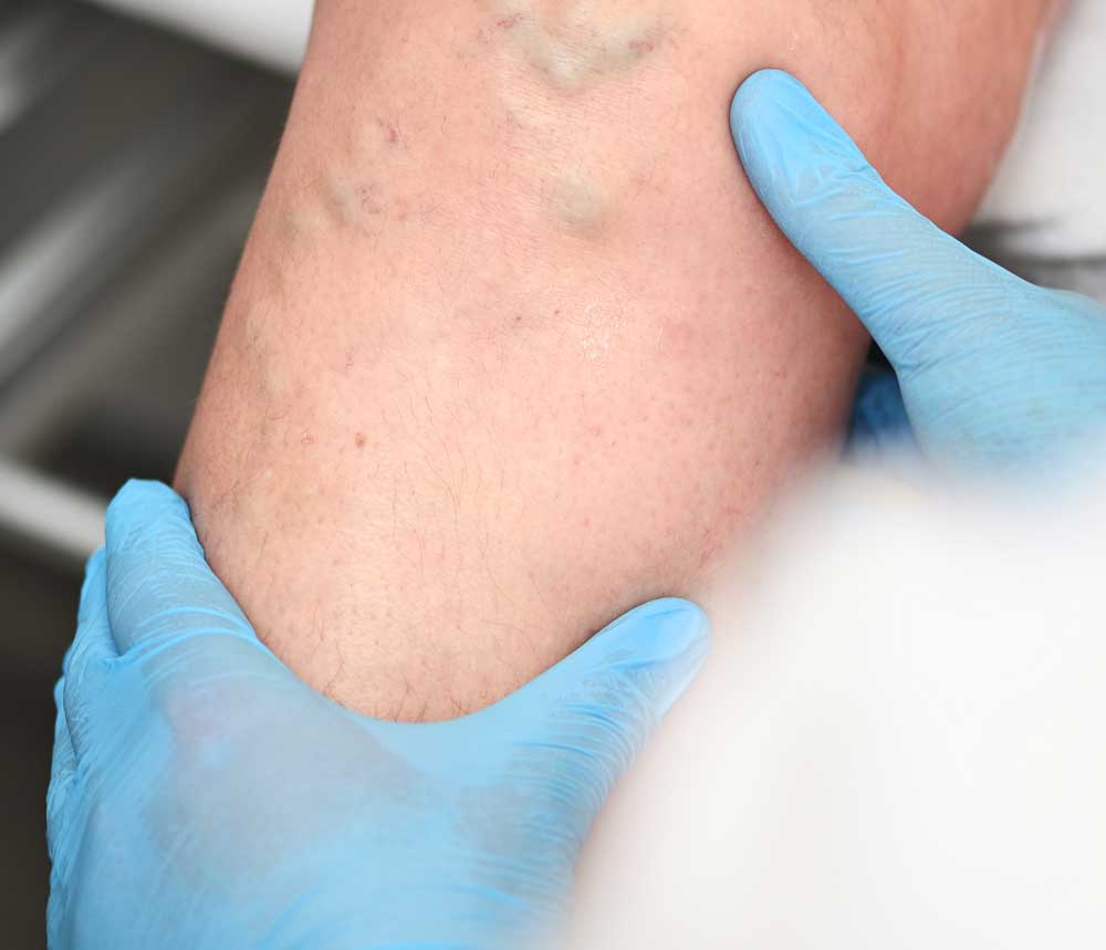 Chronic Venous Care in Stuart, Florida Expert Care at Symmetry Vascular Center
