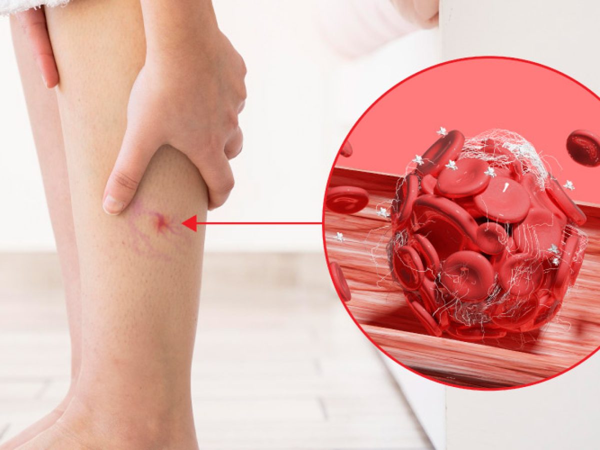 Chronic Venous Care in Stuart, FL at Symmetry Vascular Center