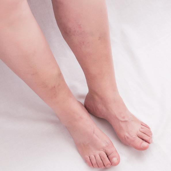 Venous Insufficiency Specialist in Hobe Sound FL At Symmetry Vascular Center