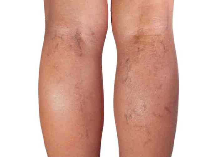 Venous Insufficiency Treatment in Stuart, FL Symmetry Vascular Center