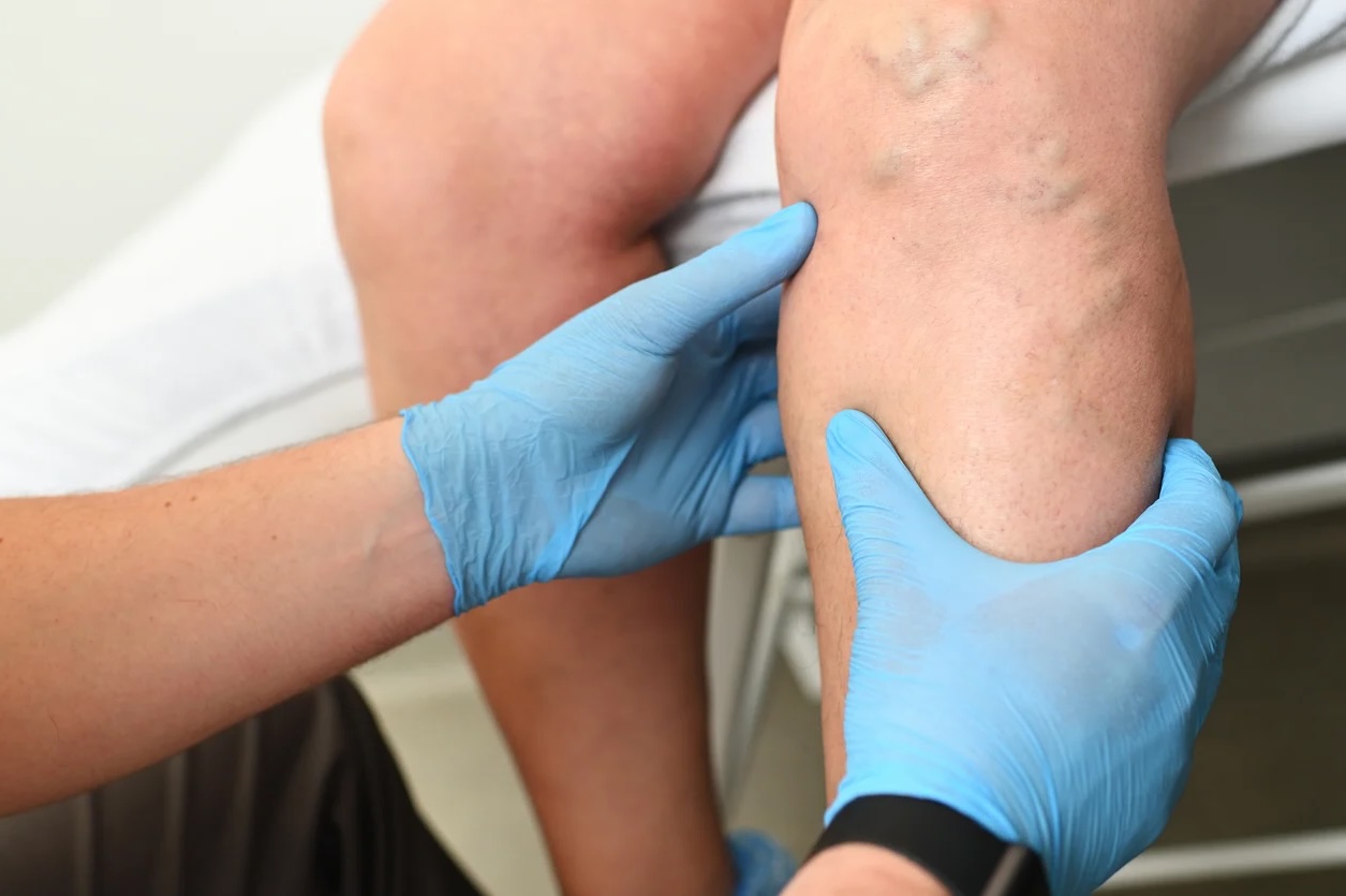 Modern Endovascular Care in Stuart, FL Symmetry Vascular Center