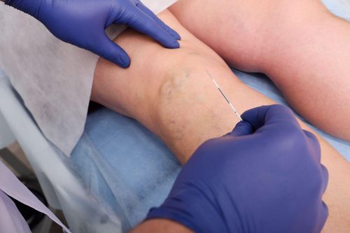Non-Surgical Vein Treatment in Port St. Lucie, FL